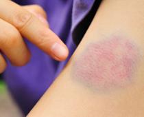 ful-bruise-B.jpg