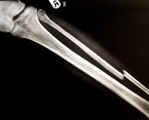 ure-fracture-B.jpg
